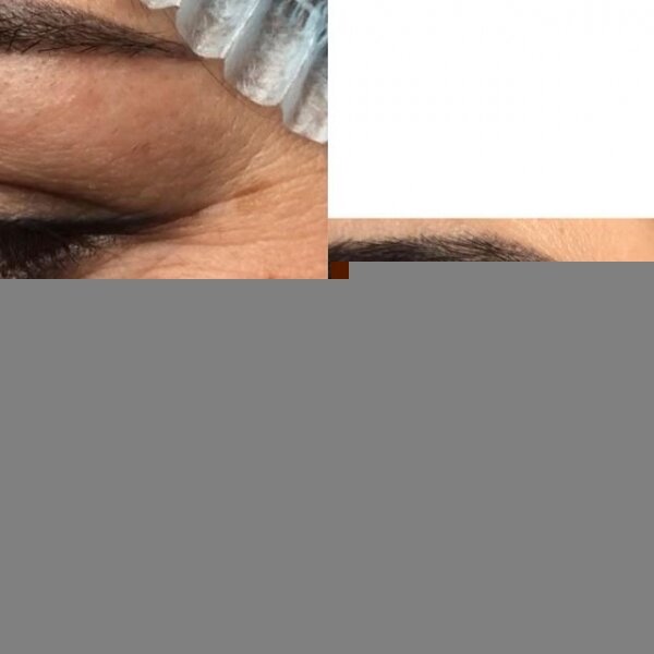 В глаза смотри: что делать с нежной кожей век? От косметологии и хирургии до массажа и косметики 