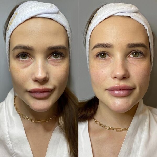 В глаза смотри: что делать с нежной кожей век? От косметологии и хирургии до массажа и косметики 