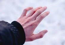 Врач Сирмайс объяснила, о чем могут говорить покраснений на коже после мороза